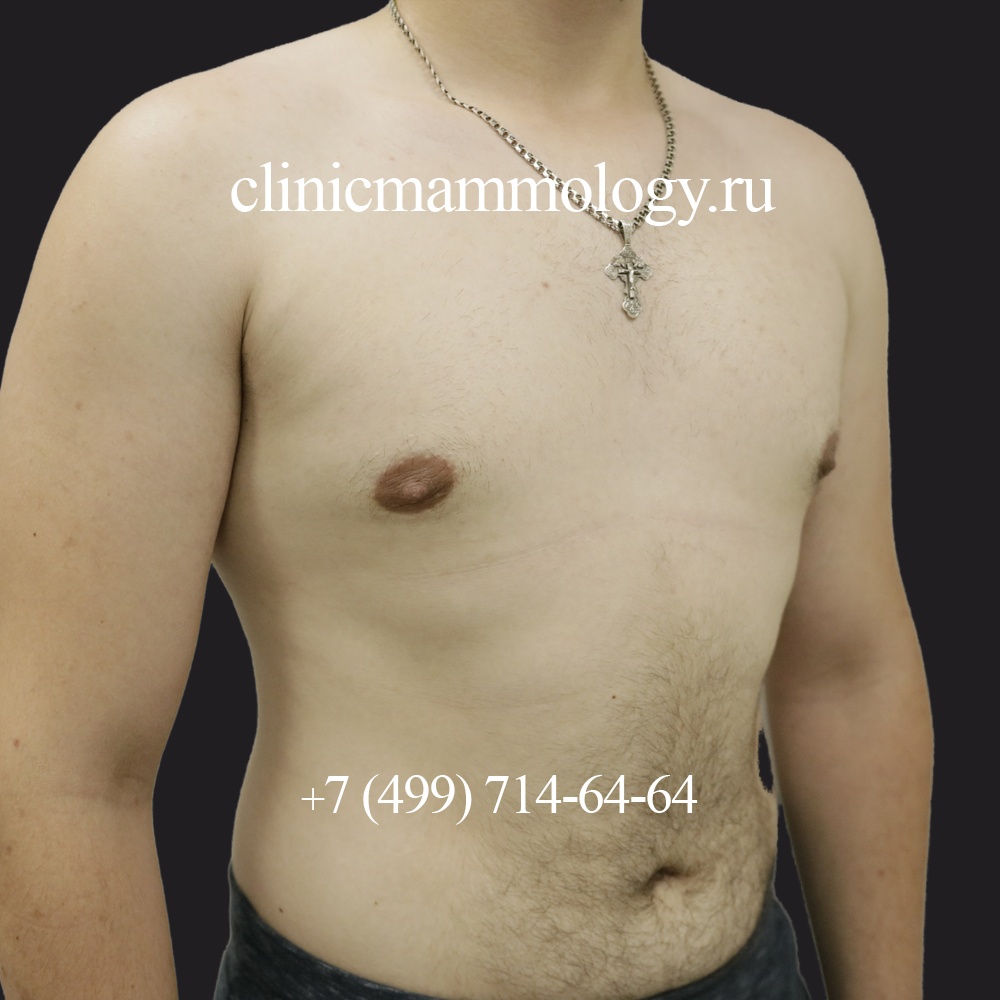 Эстетический контур мужской груди после лечения гинекомастии 2 типа у мужчины, в три четверти