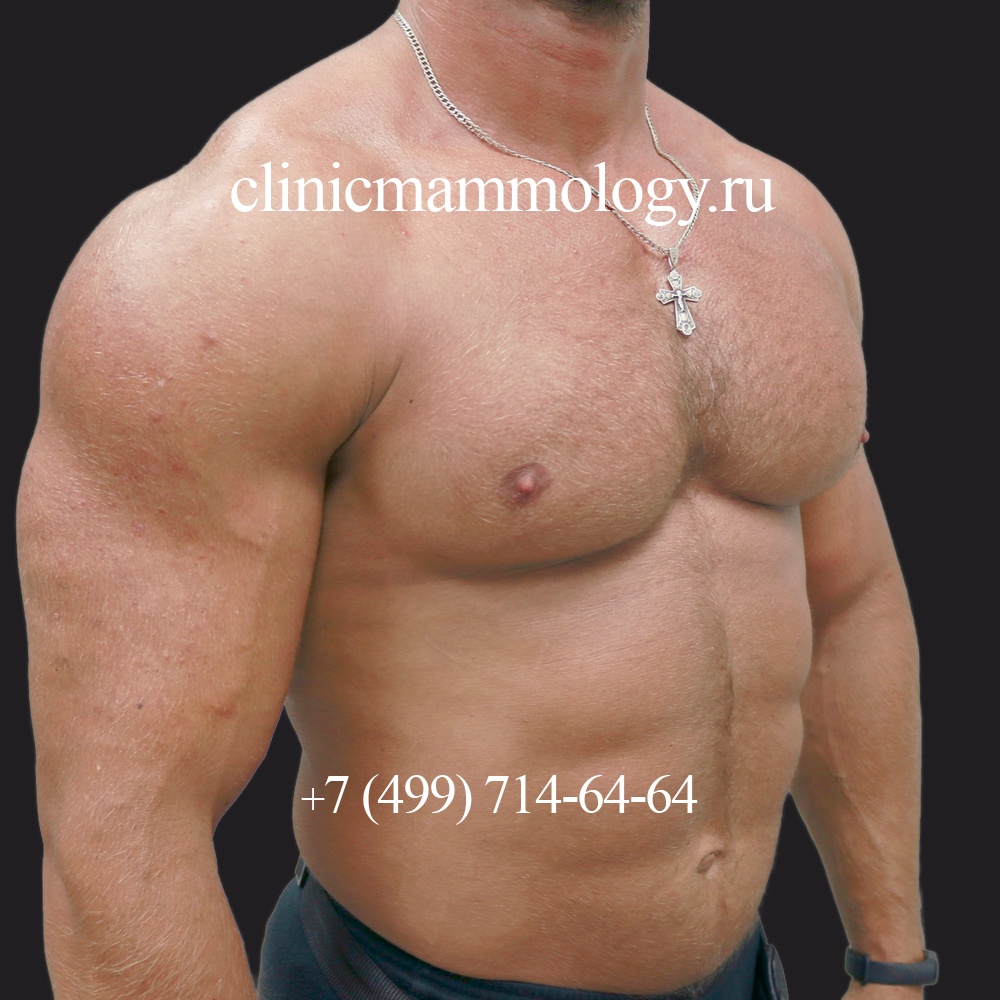 Эстетический контур мужской груди после лечения гинекомастии у бодибилдера, в три четверти