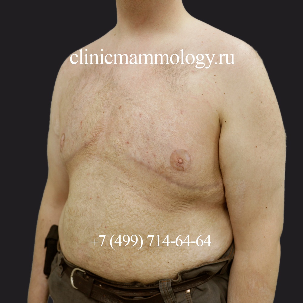 Эстетический контур мужской груди после лечения липомастии 4 типа, в три четверти