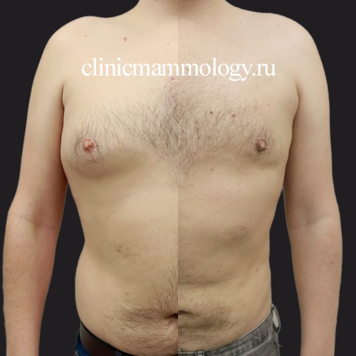 Липомастия 3 типа у мужчины