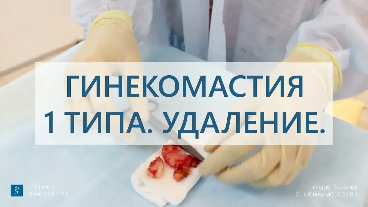 Превью: Гинекомастия 1 типа: удаление у мужчины