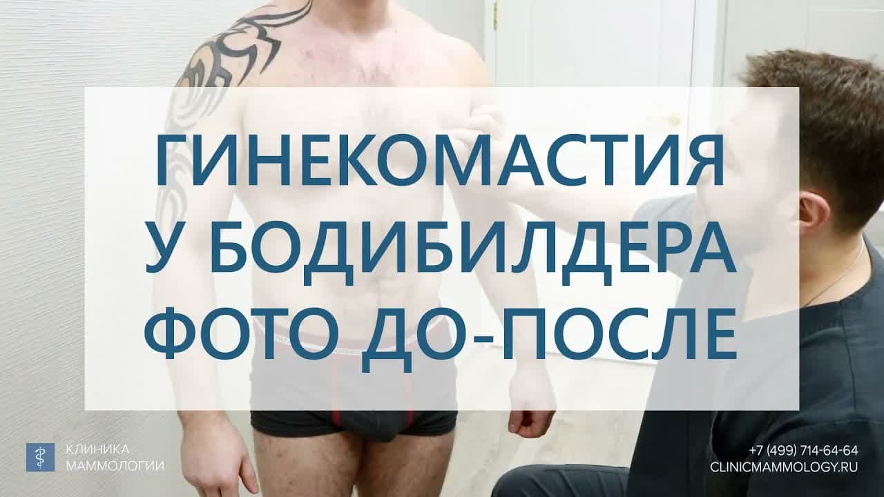 Превью: Гинекомастия 2 типа у бодибилдера: операция и результат
