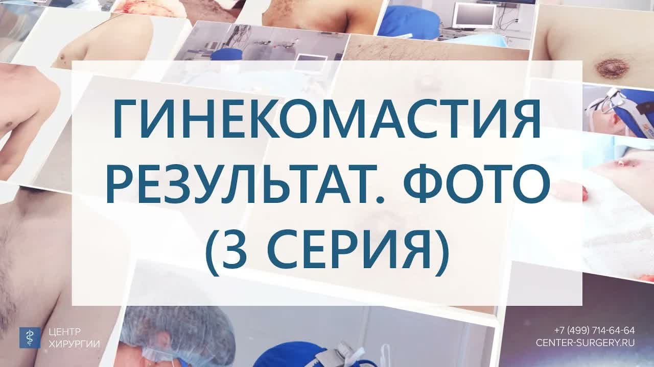Превью: Результат удаления подростковой гинекомастии 2 типа