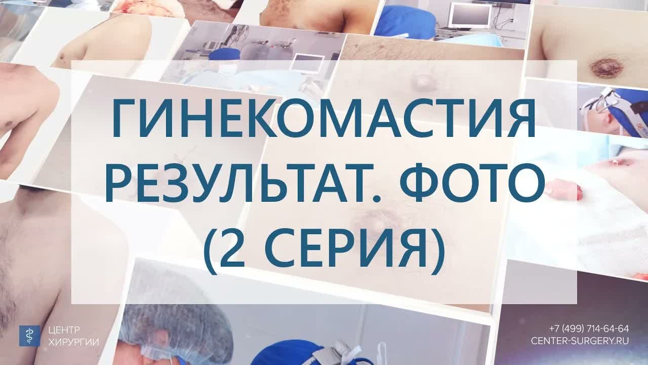 Превью: Результат удаления смешанной гинекомастии 4 типа