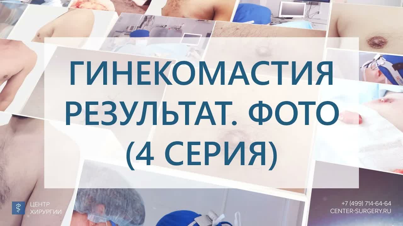 Превью: Гинекомастия у мужчин: результат удаления истинной гинекомастии