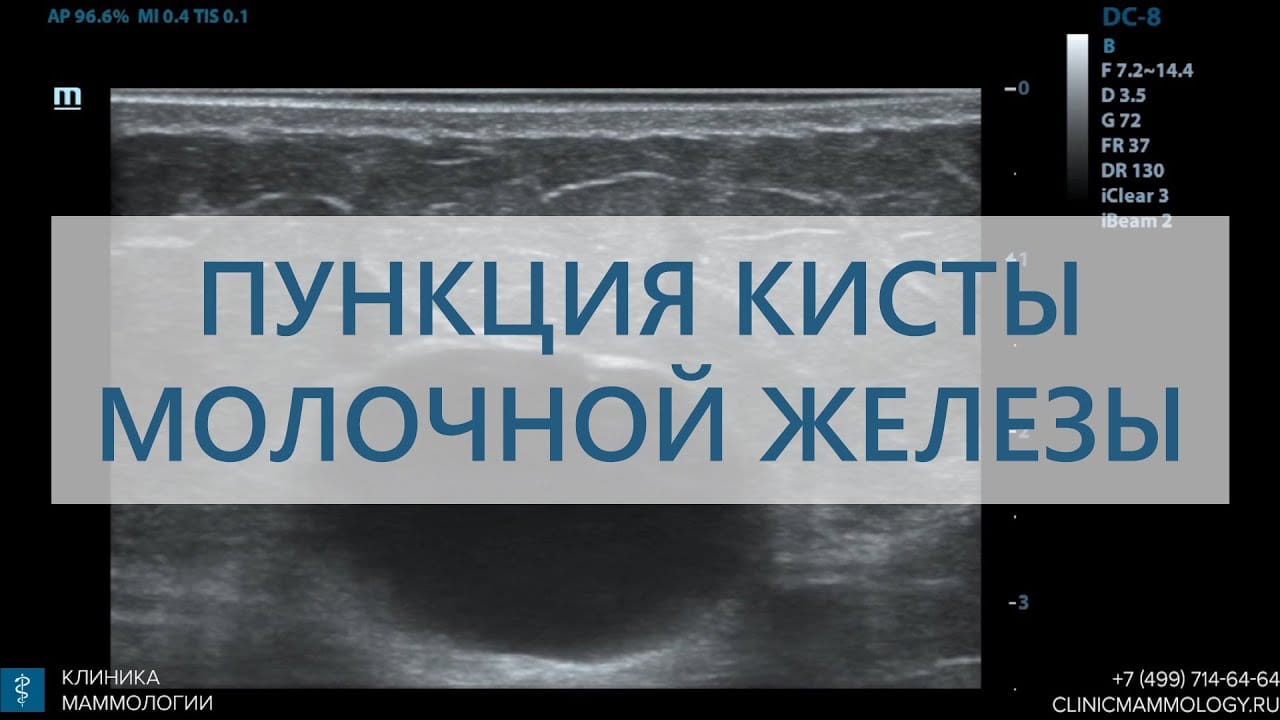 Пункция кисты молочной железы в «Клинике Маммологии»