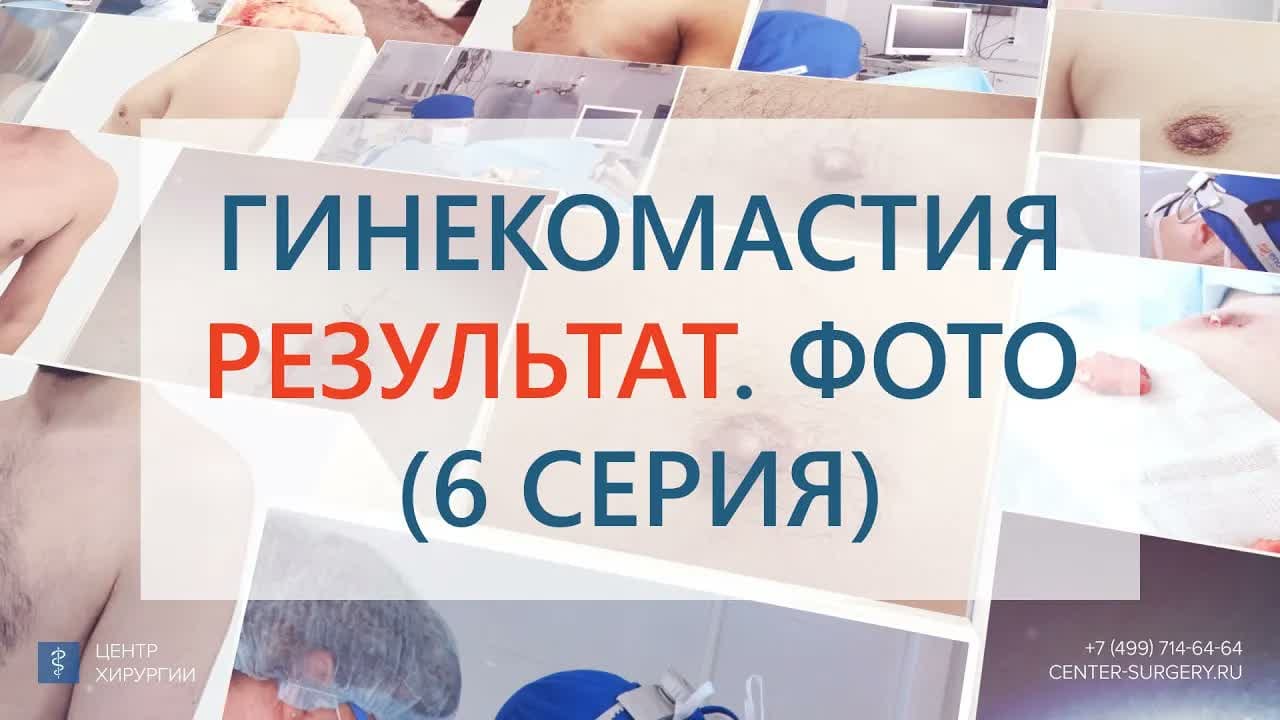 Превью: Результат удаления смешанной гинекомастии 3 типа