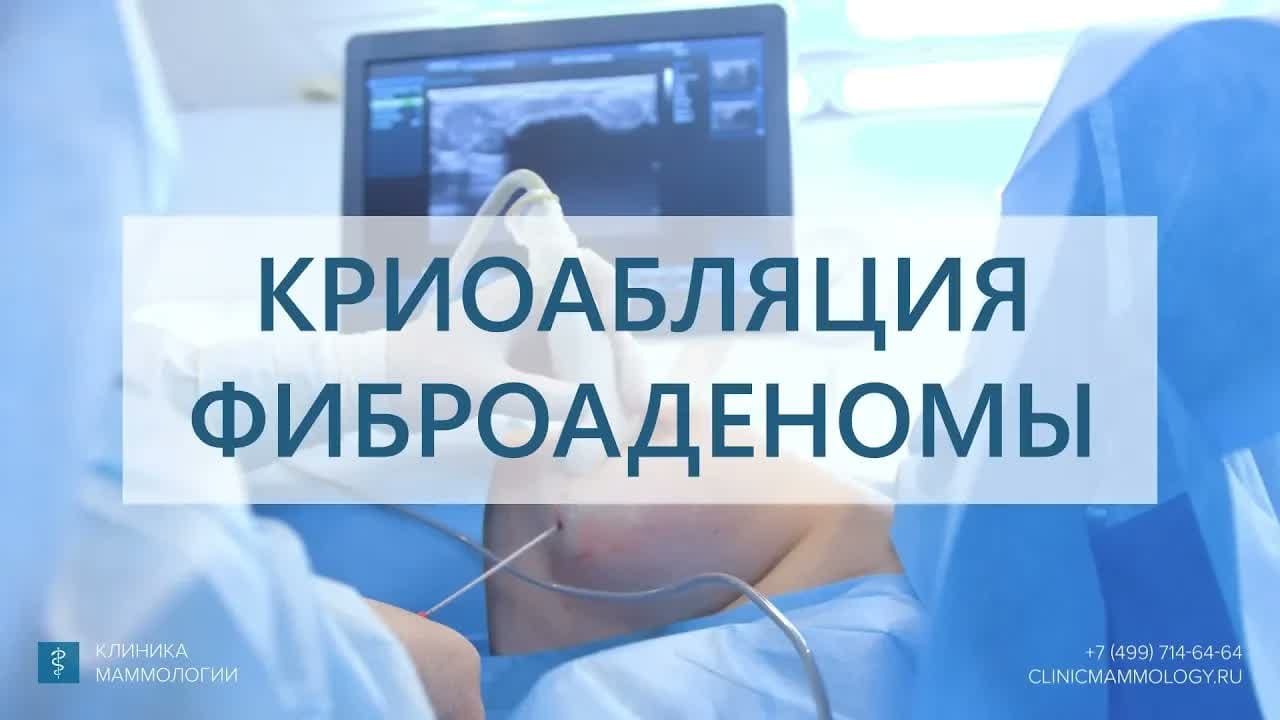 Превью: Удаление фиброаденомы: криоабляция опухоли